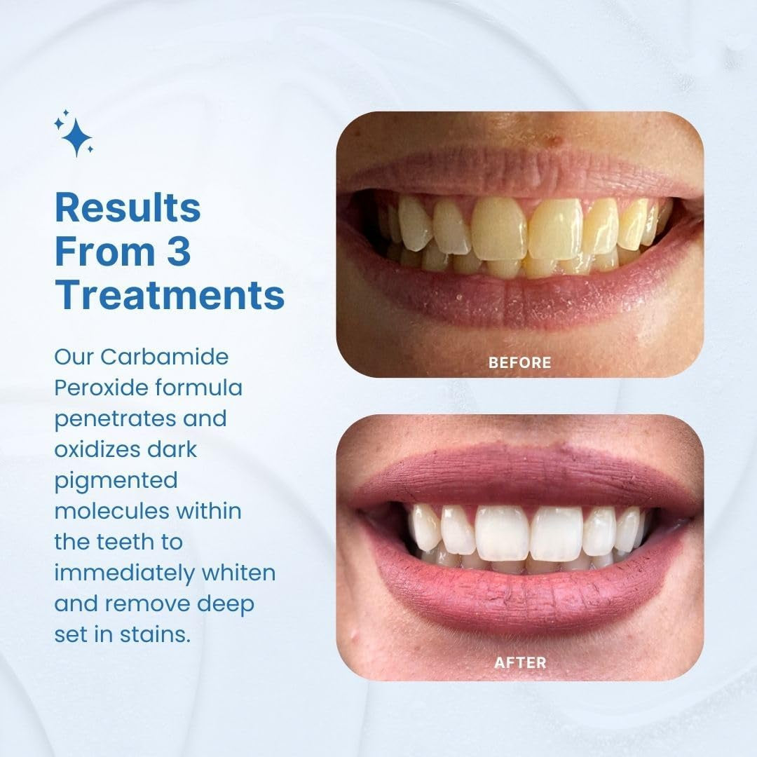 Teeth Whitening Kit, Complete LED Teeth Whitening, 15+ Treatments, (3) 3Ml Whitening Gel Syringes, Whiter Smile in 7 Minutes